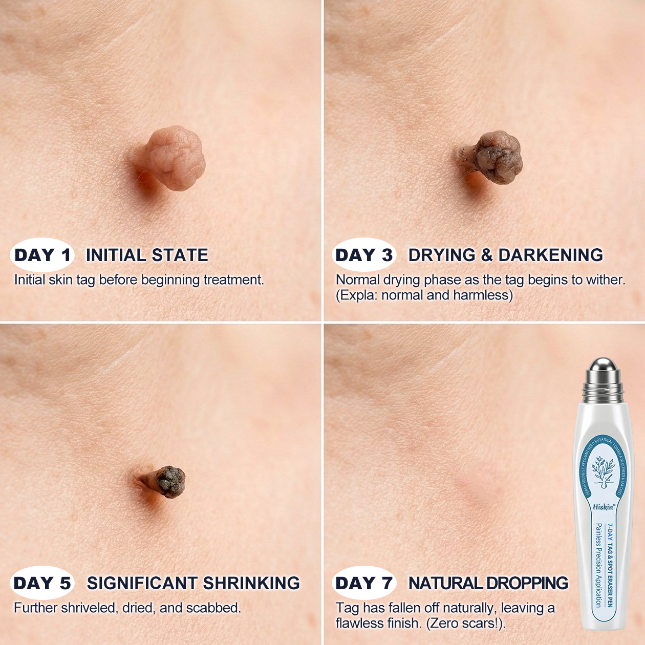 Hiskin® 7-𝐷𝑎𝑦 𝗧𝐚𝐠 & 𝗦𝗽𝐨𝐭 𝐄𝐫𝒂𝒔𝒆𝒓(Zero Pain, Zero 𝐒𝐜𝐚𝒓𝒔 Rollerball)