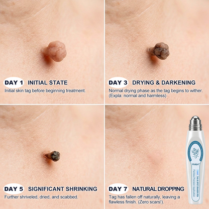 Hiskin® 7-𝐷𝑎𝑦 𝗧𝐚𝐠 & 𝗦𝗽𝐨𝐭 𝐄𝐫𝒂𝒔𝒆𝒓(Zero Pain, Zero 𝐒𝐜𝐚𝒓𝒔 Rollerball)