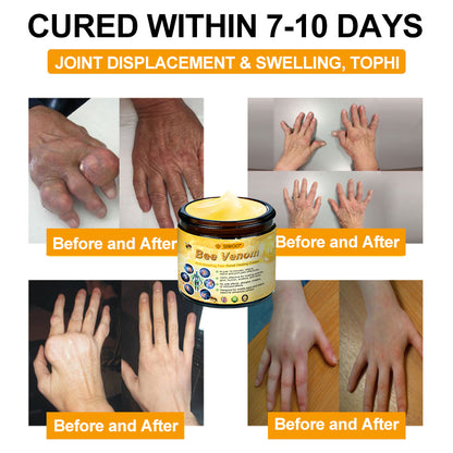 SIWOO® Bee Venom Anti-Swelling Pain Relief Healing Cream