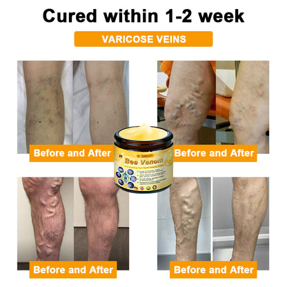 SIWOO® Bee Venom Anti-Swelling Pain Relief Healing Cream