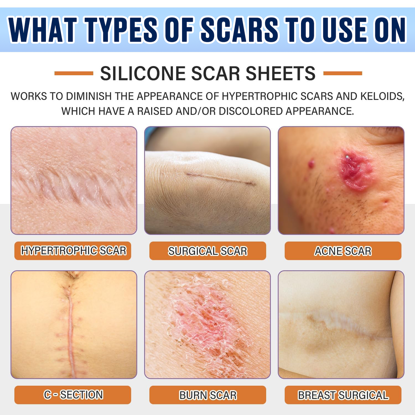 Icystar®Tranexamic Acid silicone scar sheets
