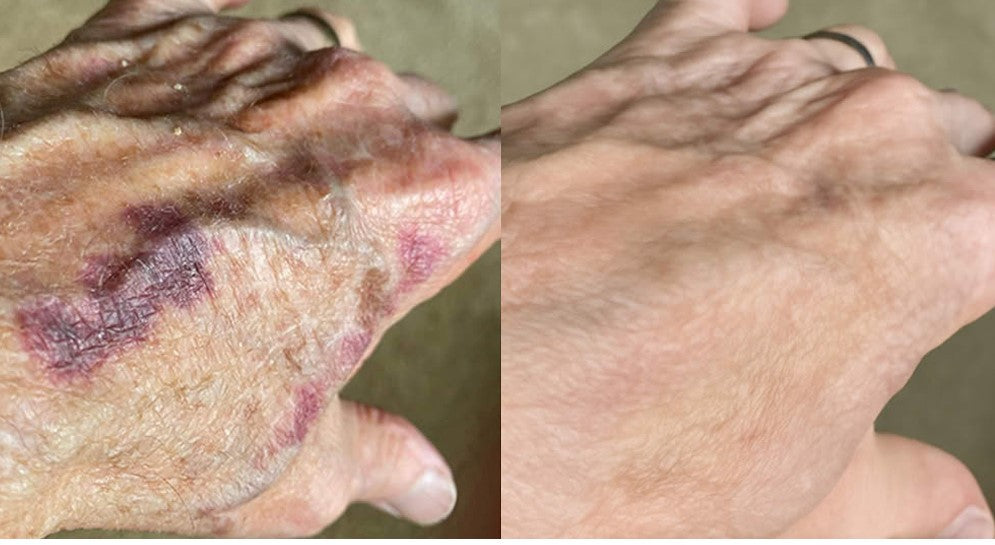 Icystar®Tranexamic Acid silicone scar sheets
